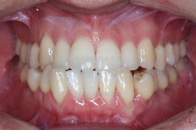 부산비수술교정