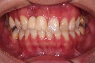 연산동치아교정