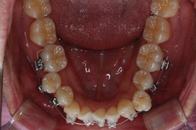 부산비수술교정