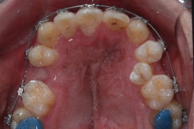 부산구순구개열