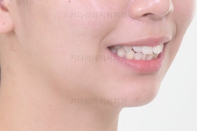 부산사랑니교정