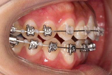 부산치아교정치과