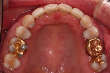 동래임플란트교정
