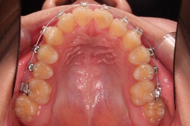 부산비발치교정