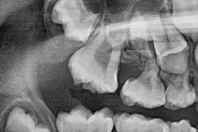 부산어린이치아교정