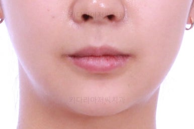 부산안면비대칭