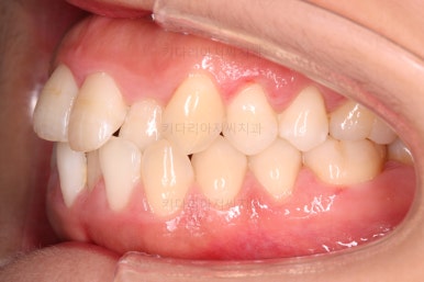 부산비발치교정