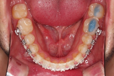 부산긴얼굴긴턱교정