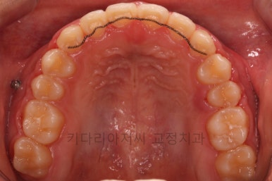 연산동치아교정