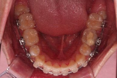 부산청소년치아교정
