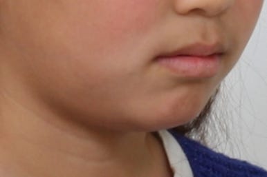 연산동덧니교정