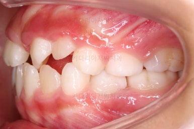 부산어린이반대교합