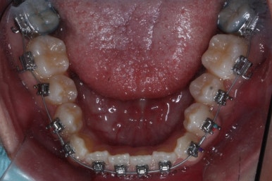 부산주걱턱교정