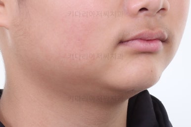 부산성장기교정
