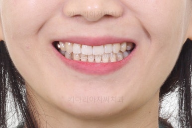 부산인비절라인