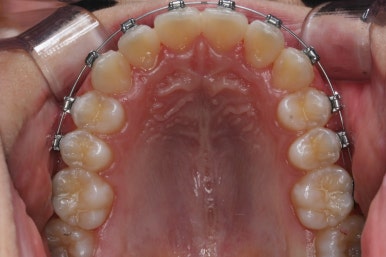 부산비발치교정