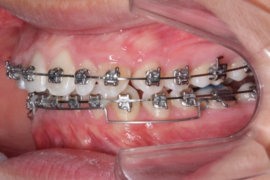 부산왜소치교정