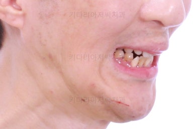 부산구순구개열교정