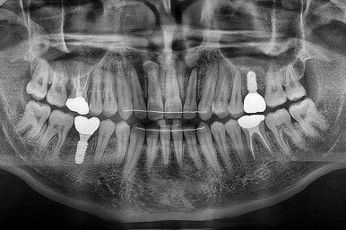 연산동임플란트