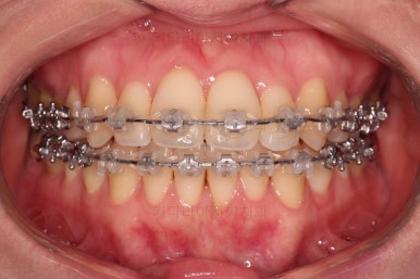 부산치아교정잘하는곳