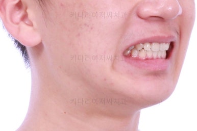 부산청소년치아교정