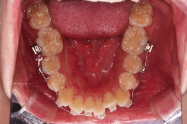 부산돌출입교정