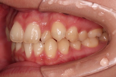 부산비발치교정