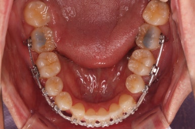 부산비수술교정