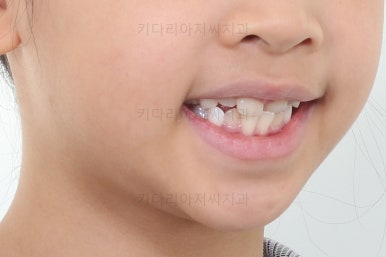 부산어린이반대교합