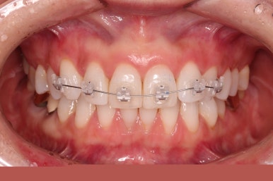 연산동부분교정