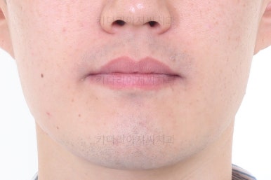 부산비수술교정