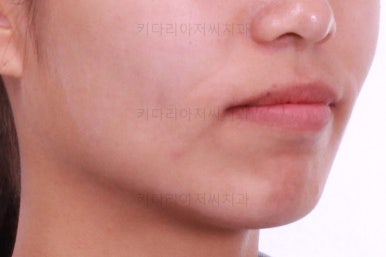 부산연산역치아교정