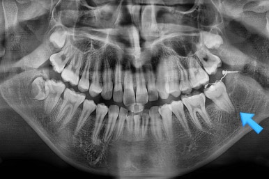 부산연산동사랑니발치