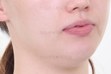 부산비대칭교정