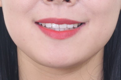 부산연산동교정치과