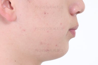 부산청소년치아교정