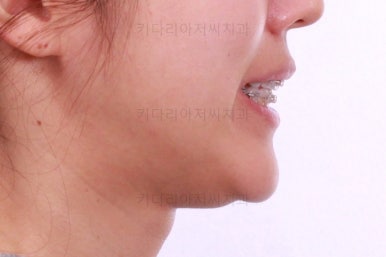 부산치아교정잘하는곳