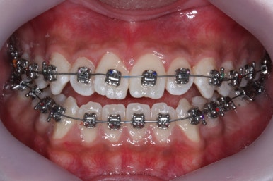 부산주걱턱교정