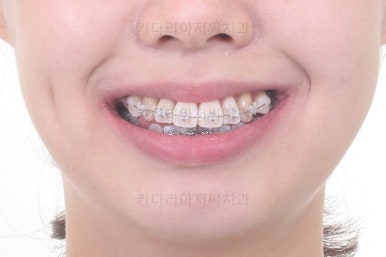 부산치아교정잘하는치과
