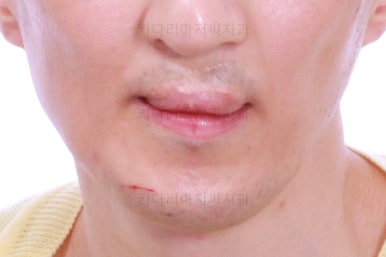 부산구순구개열교정