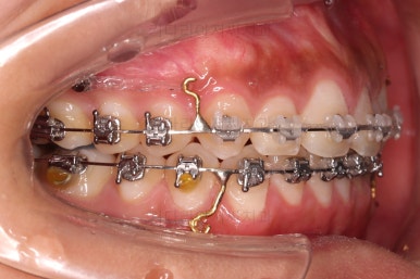 부산치아교정치과