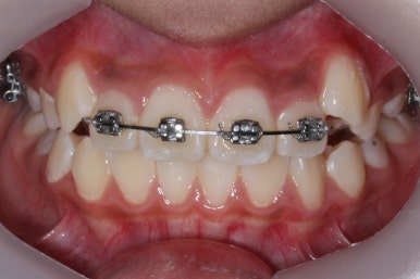 연산동덧니교정