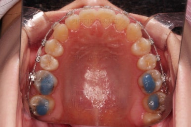 부산치아교정추천