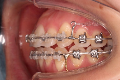 부산비발치교정