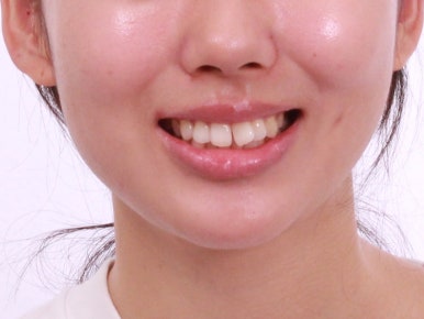 부산덧니교정
