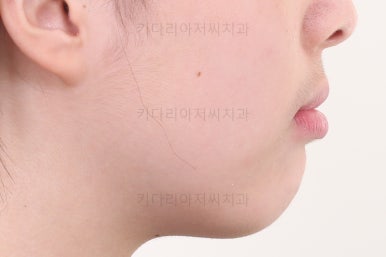 부산투명교정