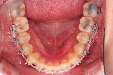 부산돌출입교정