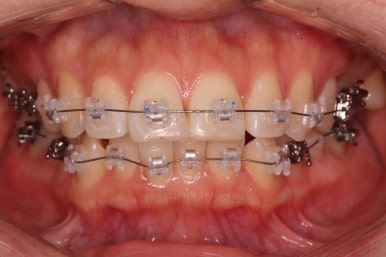 부산연산동교정치과