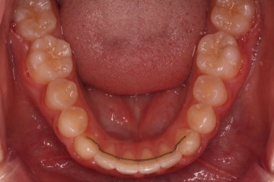 부산비발치교정