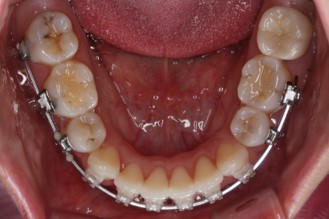 부산연산동교정치과